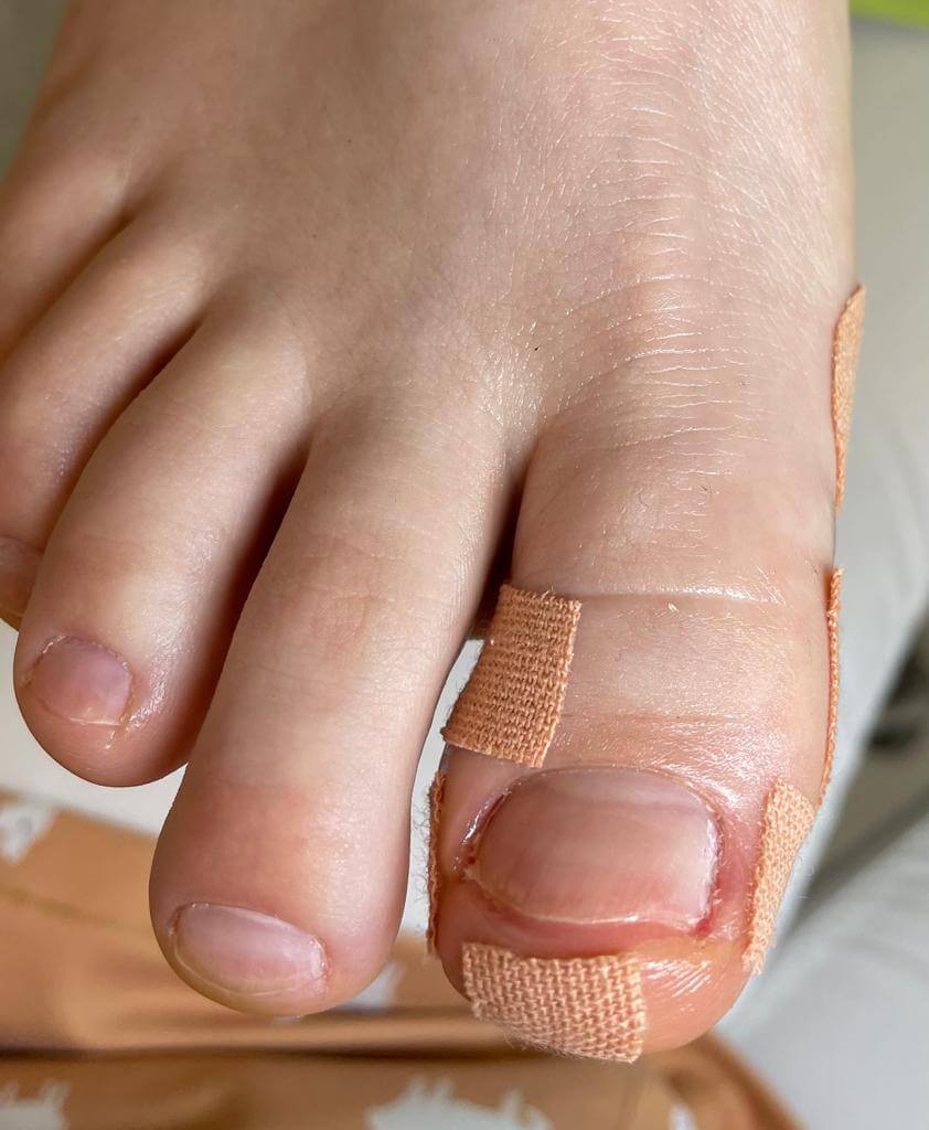 terapia infekcji paAeczkA ropy bAAkitnej po